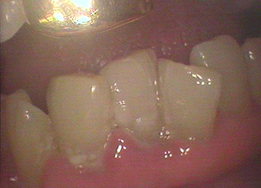 歯石取りの重要性 栗原歯科医院 北区 東十条 王子神谷エリアの歯医者