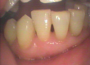 歯石除去後（数週間経過）